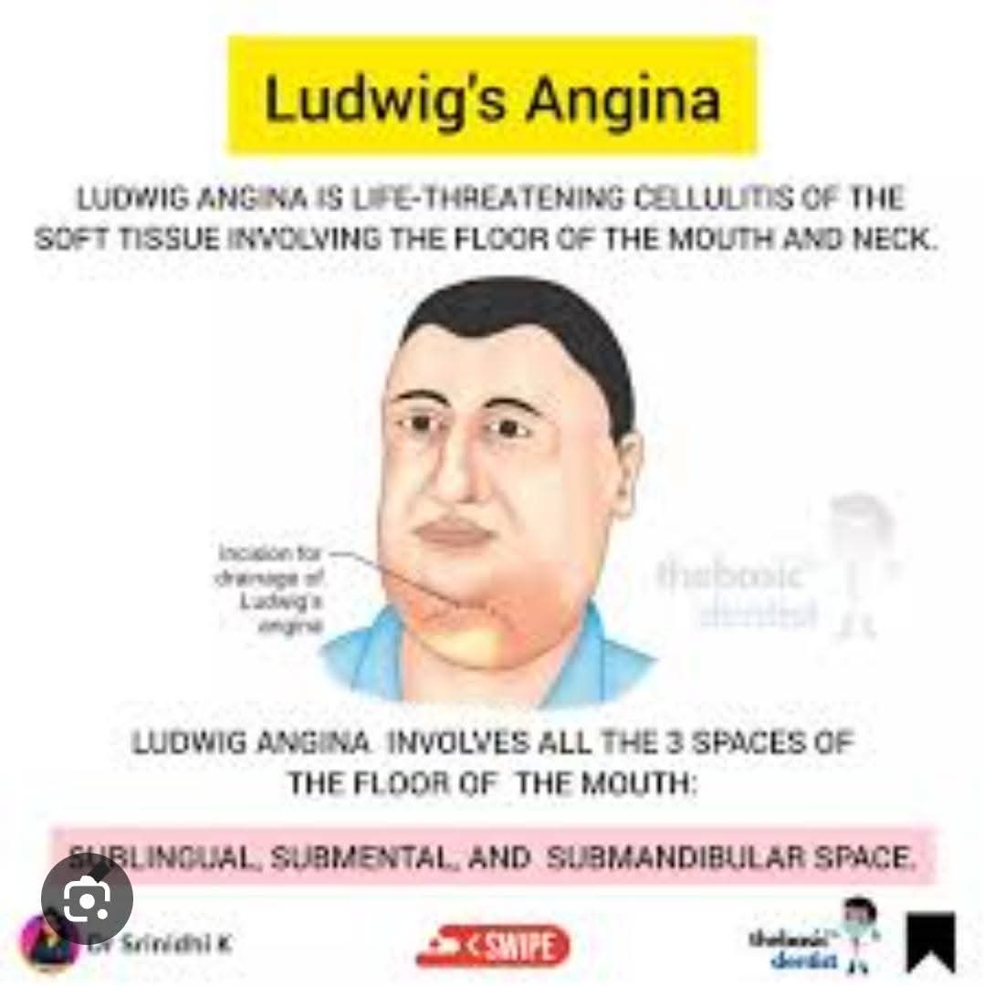 KULA DA LAFIYA: Ludwig’s Angina: Cikakken Bayani daga Bangaren Lafiya