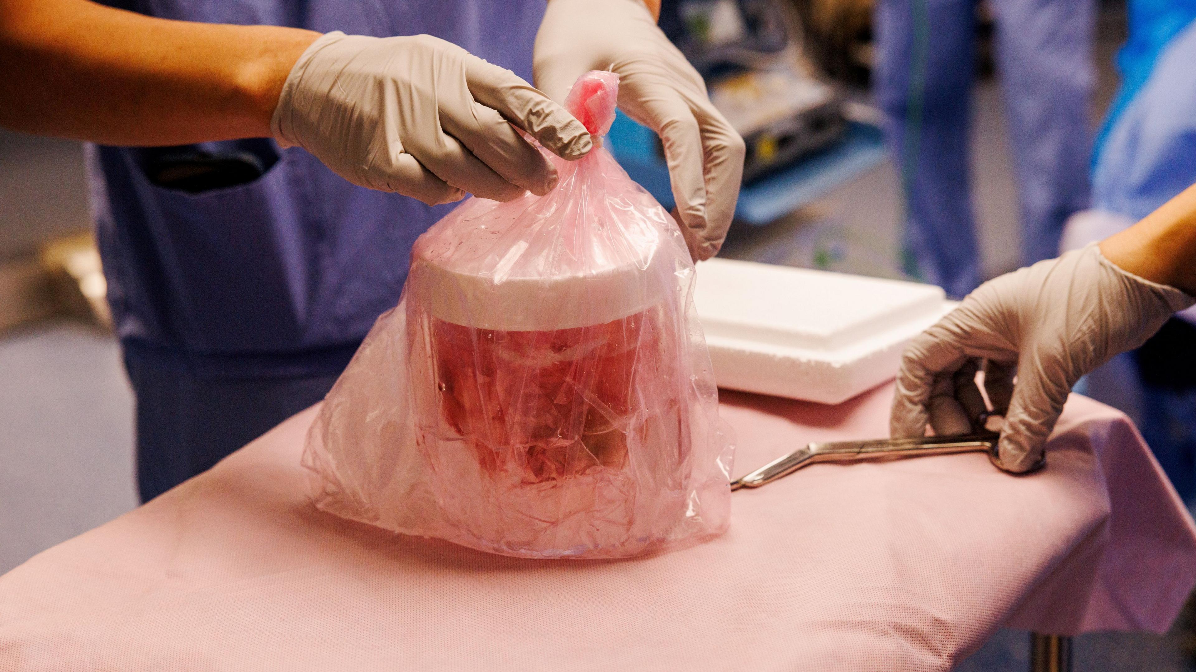 Pig Kidney Functions in Human for Record 271 Days, Raising Hope for Transplant Patients